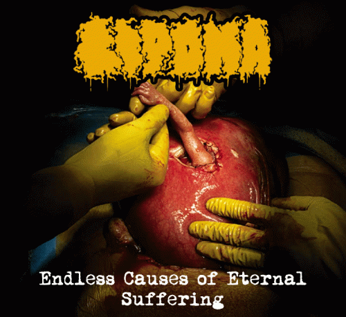 Lipoma : Endless Causes of Eternal Suffering